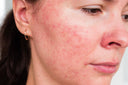Is It Normal for My Skin to Be Red and Sensitive After a Procedure?