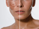 Chemical Peel Recovery: How to Prep, Heal, and Protect Your Skin