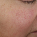 Before and after results of person’s face before and after using the skin renewing night cream, The Night Synthesis